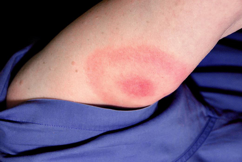 A bull's eye or erythema migrans rash that manifested on this woman's upper arm signifies a case of Lyme disease.